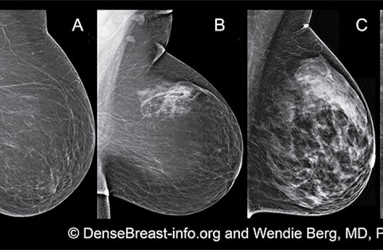 Breast Density